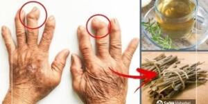 İ’ltihaplı Eklem Romatizmasına Ne İyi Gelir, Nasıl Geçer