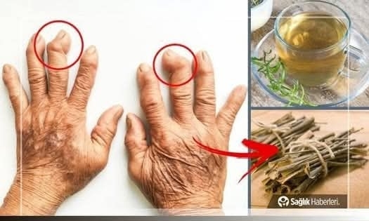 İ’ltihaplı Eklem Romatizmasına Ne İyi Gelir, Nasıl Geçer