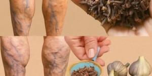 Bacak ağrısı, romatizma, varis, artrit.