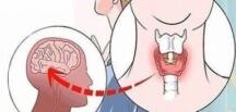 Tiroid Hastası Olduğunuzun 6 Saklı İşareti